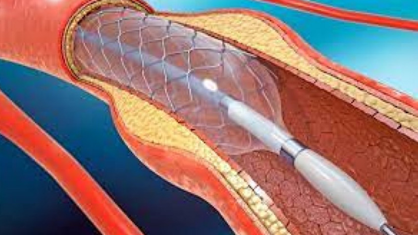 stent